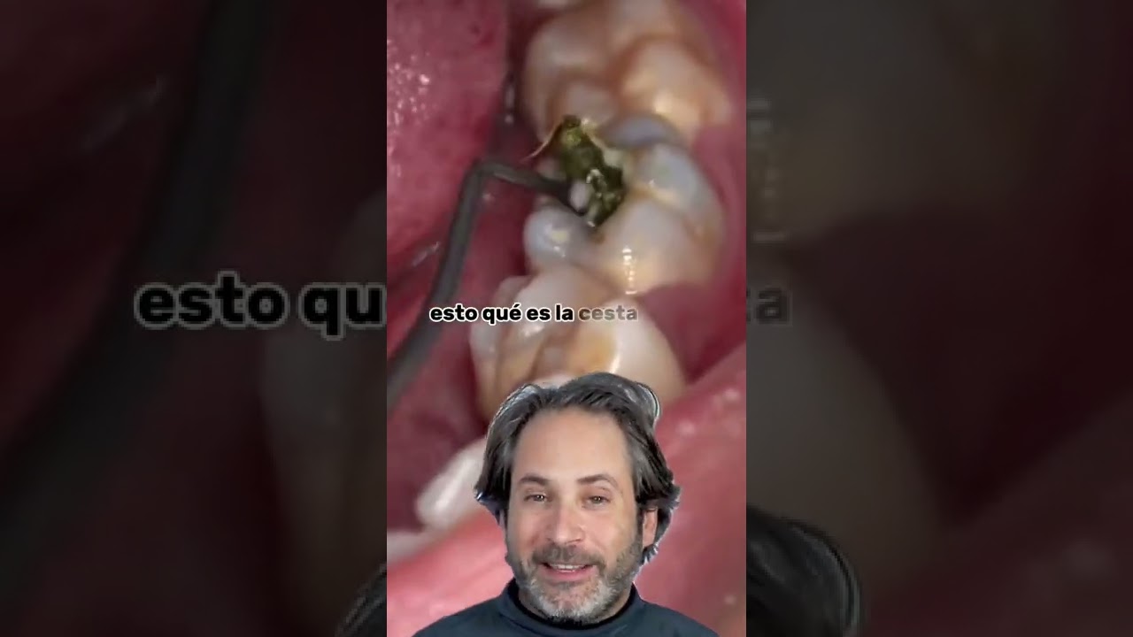 Cómo evitar el dolor de muela por comida atorada
