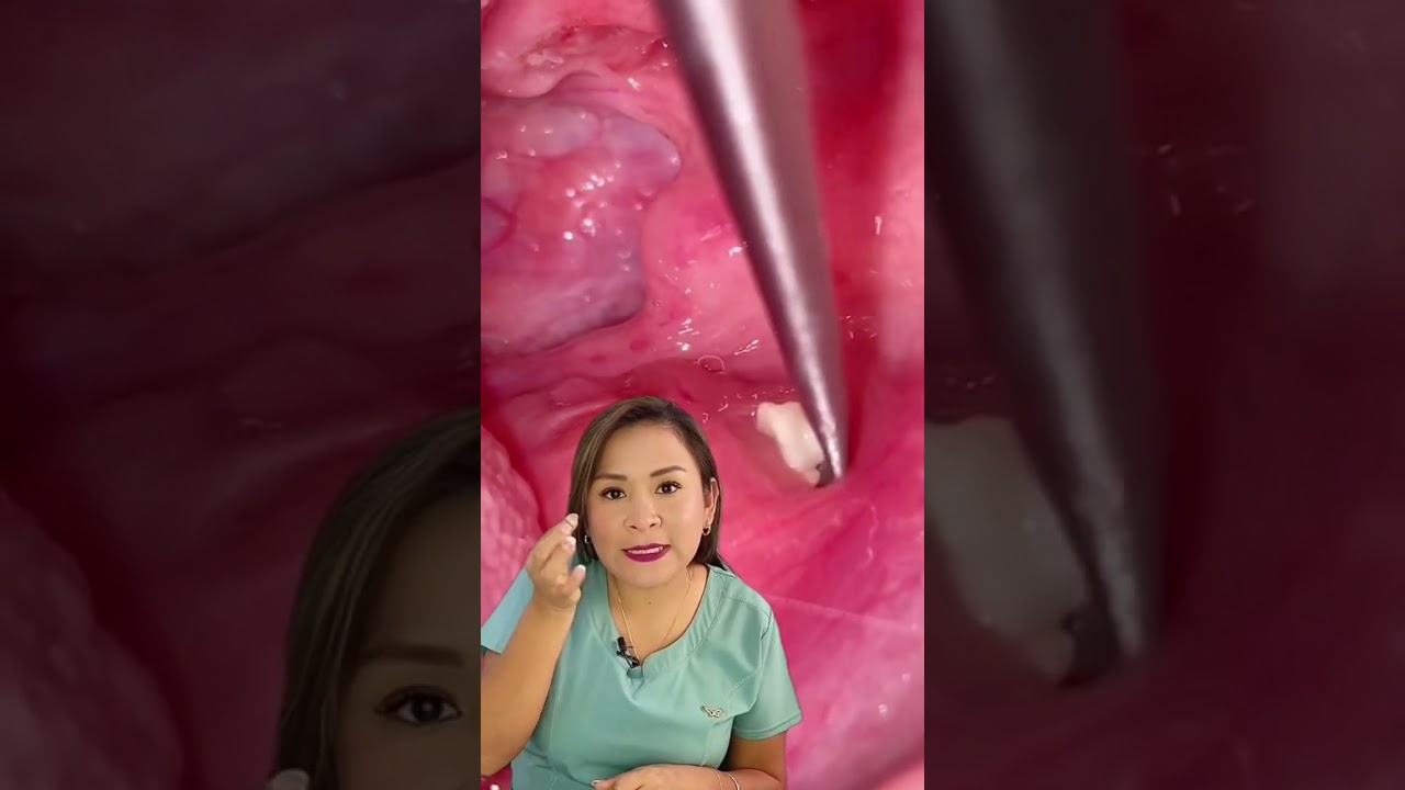 Cómo desatascar la comida atorada en las anginas