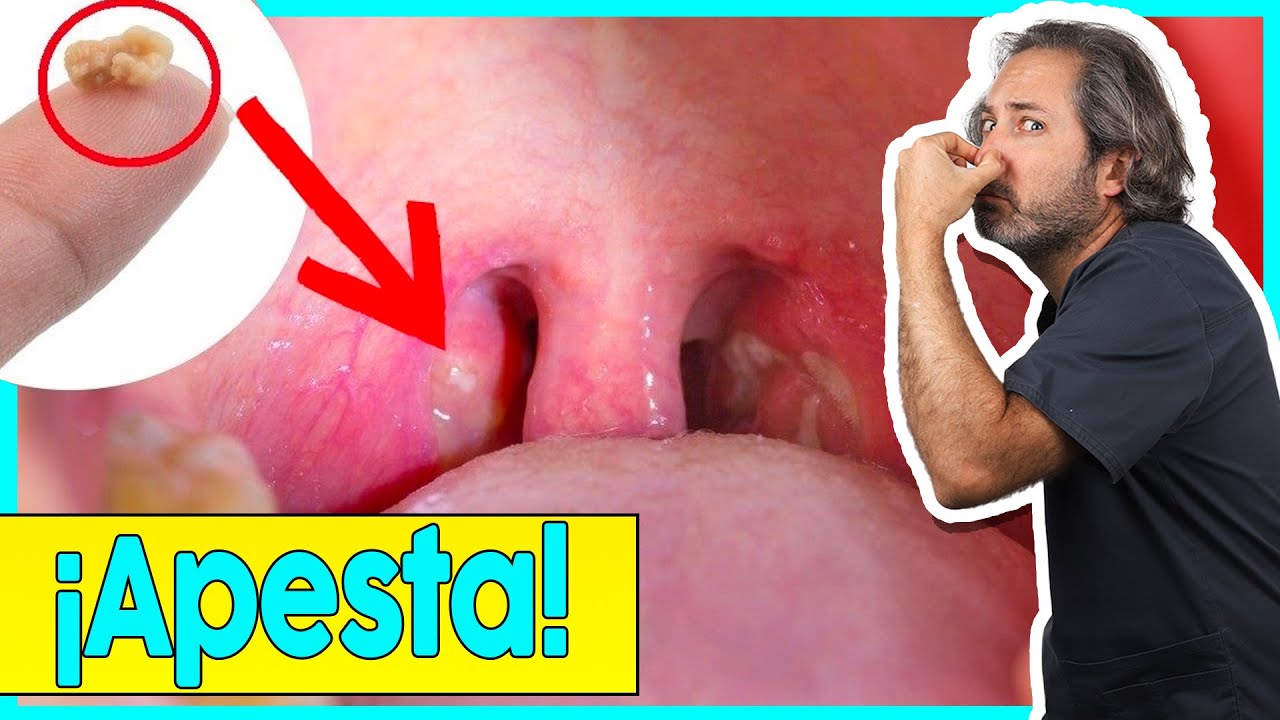 Higiene bucal evita acumulación de comida en amígdalas