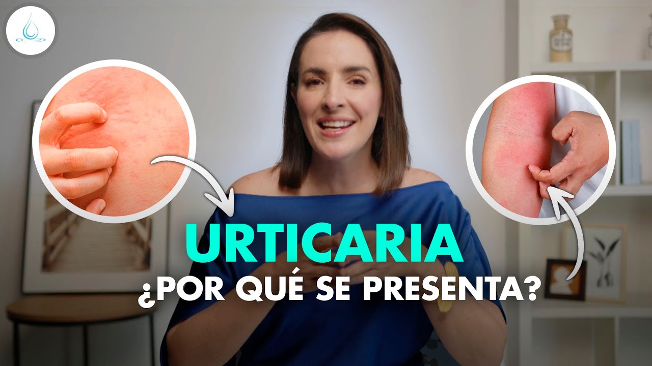 Urticaria causada por consumo de comida en mal estado