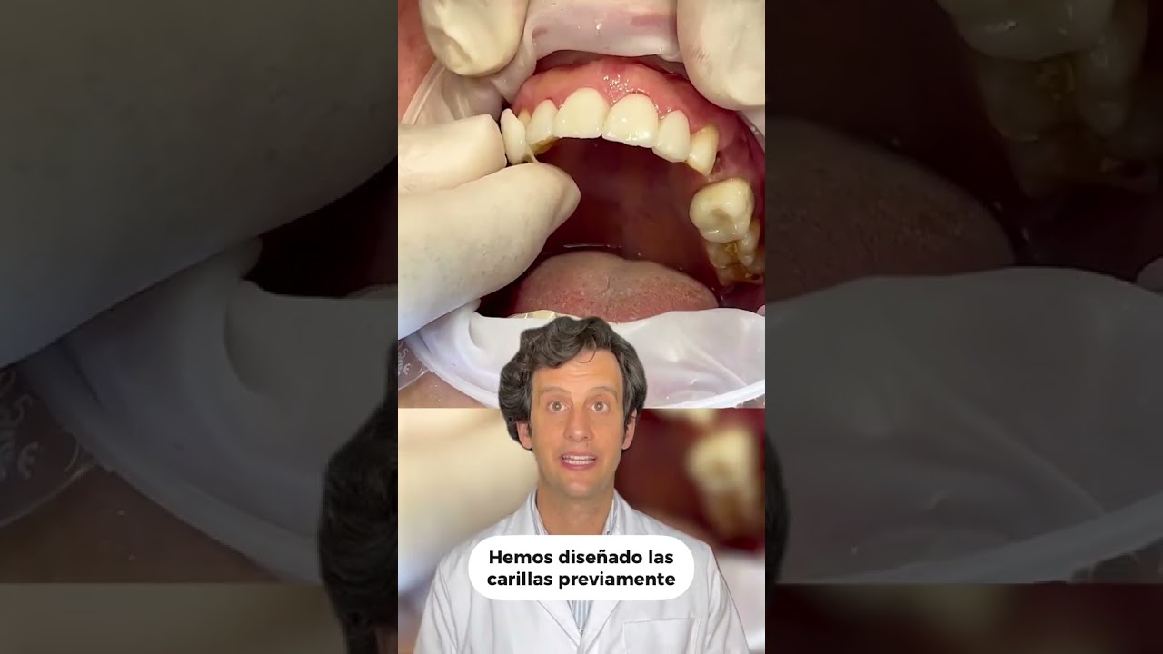 Conoce las carillas de comida para una sonrisa perfecta